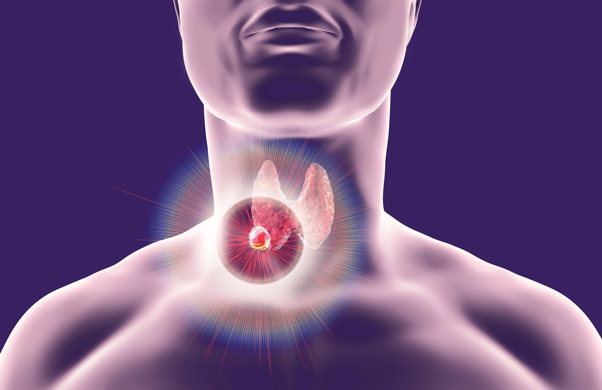 甲状腺结节分几种